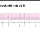 BLOCK NHĨ THẤT CẤP III CHẨN ĐOÁN VÀ XỬ TRÍ
