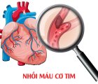 Can thiệp mạch vành