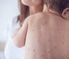 Cách nhận biết và xử lý sốt phát ban ở trẻ sơ sinh