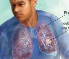 Bước đột phá trong điều trị ung thư Phổi