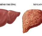 NHỮNG HIỂU BIẾT VỀ BỆNH XƠ GAN