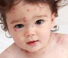 Bệnh thủy đậu: Nguyên nhân, triệu chứng, biến chứng và cách điều trị