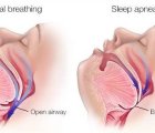 Ngừng thở khi ngủ: Nguyên nhân, biểu hiện, điều trị và phòng bệnh