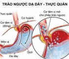 Trào ngược dạ dày thực quản: Nguyên nhân, triệu chứng, cách điều trị và phòng bệnh