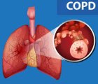 BỆNH PHỔI TẮC NGHẼN MẠN TÍNH (COPD)