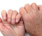 Bệnh da thường gặp khi chuyển mùa Hè sang Thu và cách phòng tránh