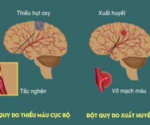 Nhồi máu não cấp do đâu?