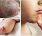 Viêm nang lông ở trẻ có nguy hiểm không?