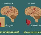 Nhồi máu não cấp do đâu?